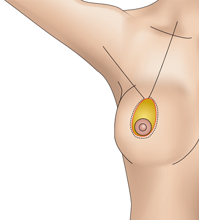 乳房挙上術（ドーナッツペクシー法）のプロセス3