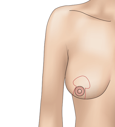 乳房挙上術（バーティカル法）のプロセス1