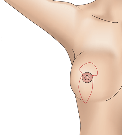 乳房挙上術（バーティカル法）のプロセス2