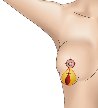 乳房挙上術（バーティカル法）のプロセス5