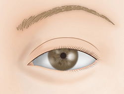 眉毛下切開法（眉下リフト）の施術プロセス その1