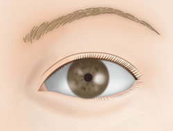 眉毛下切開法（眉下リフト）の施術プロセス その5