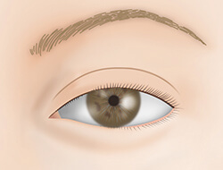 眼瞼挙筋短縮法（眼瞼下垂の手術）の施術プロセス その1