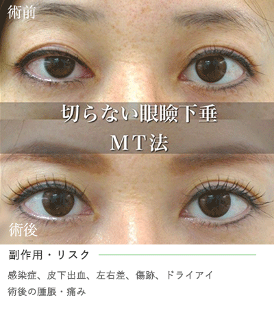 ミューラー筋タッキング法 Mt法 切らない眼瞼下垂の手術 二重整形施術なら大塚美容形成外科 歯科