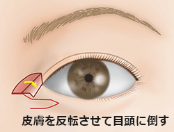 たれ目形成下眼瞼皮弁法の施術プロセス その4