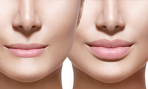 唇を厚くするヒアルロン酸注入 唇 口元の整形なら大塚美容形成外科 歯科
