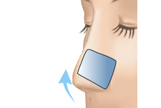 鼻中隔軟骨切除のプロセス 埋没法 正面3