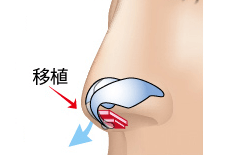鼻橋部軟骨移植のプロセス 埋没法 正面2