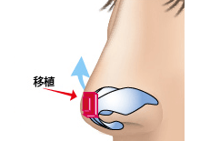 鼻尖部軟骨移植のプロセス 埋没法 正面2