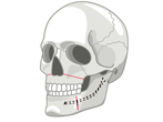 ルフォーⅠ型骨切り術＋下顎枝矢状分割法（SSRO）