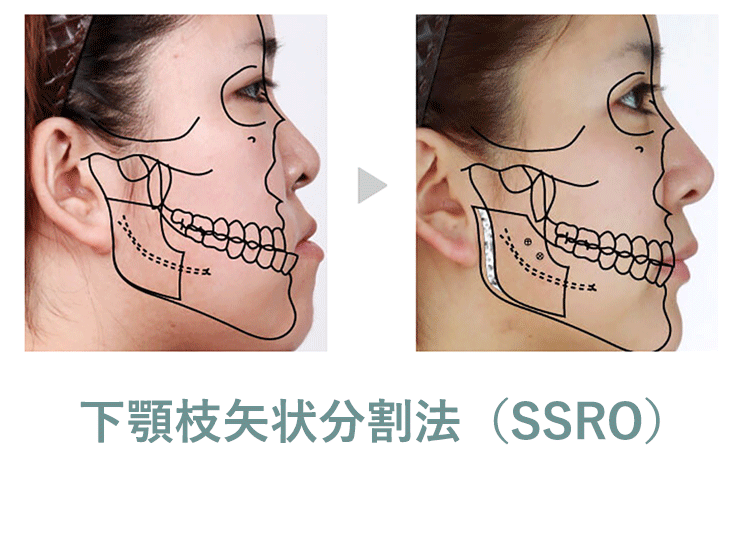 下顎枝矢状分割法（SSRO）と合わせた治療で理想のラインに