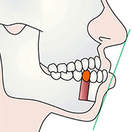 下顎骨体移動術（下あごが前に突き出ている、受け口・しゃくれ顔）