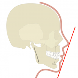 セットバック(上下顎骨体移動術)の施術プロセス2 全身麻酔・手術・入院