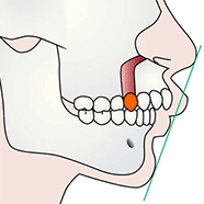 上顎骨体移動術（出っ歯、上顎が前に突き出ている、上の歯ぐきが出ている）