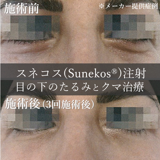 スネコス注射（sunekos）　症例写真1