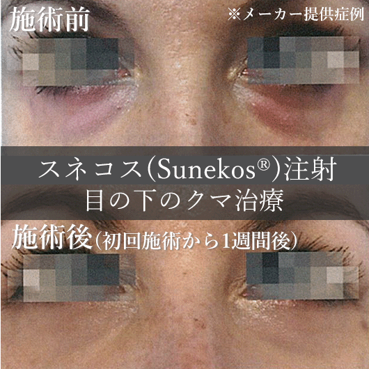 スネコス注射（sunekos）　症例写真2