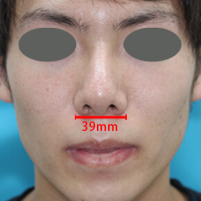 男性の鼻の症例写真 美容整形なら大塚美容形成外科 歯科